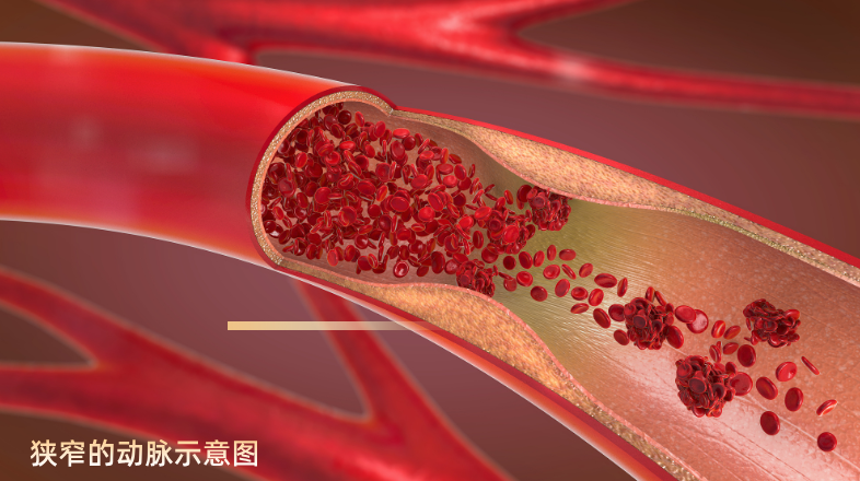 /uploads/img/20260727/cf12f5104e0054d3e0b48b8a2470924f.png 狭窄的动脉.png